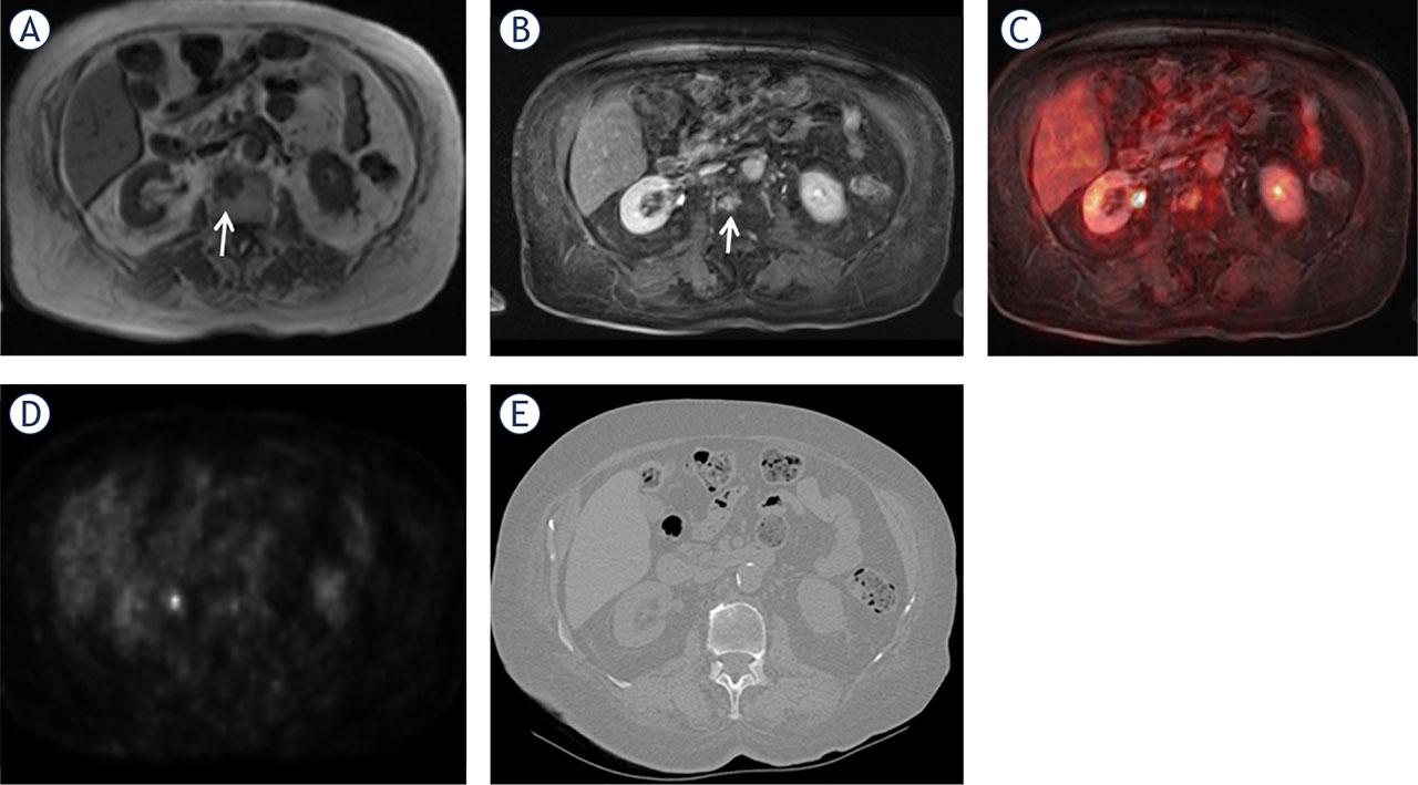 A 53-year-old woman with breast cancer. A metastasis can be observed in the L2 vertebral body (arrows) on the precontrast T1 weighted (W) image (A), contrast enhanced (CE) T1W image (B), and CE T1W VIBE-PET fused image (C). The AC PET axial image (D) does not show FDG uptake. CT yielded false-negative results (E).AC PET = attenuation-corrected raw data positron-emission tomography; FDG = fluorodeoxyglucose; VIBE = volume-interpolated breath-hold examination