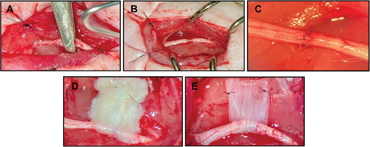 Surgical technique of the CTR procedure and application of the created hEP and hAM patch. (a) Creation of the sciatic nerve crush injury. (b) Sciatic nerve crush site 0.5 mm long. (c) End-to-end repair after resection of the sciatic nerve crush site. (d) Sciatic nerve repair site wrapped with the hEP. (e) Sciatic nerve repair site wrapped with the hAM. hAM, human amniotic membrane; hEP, human epineural patch.
