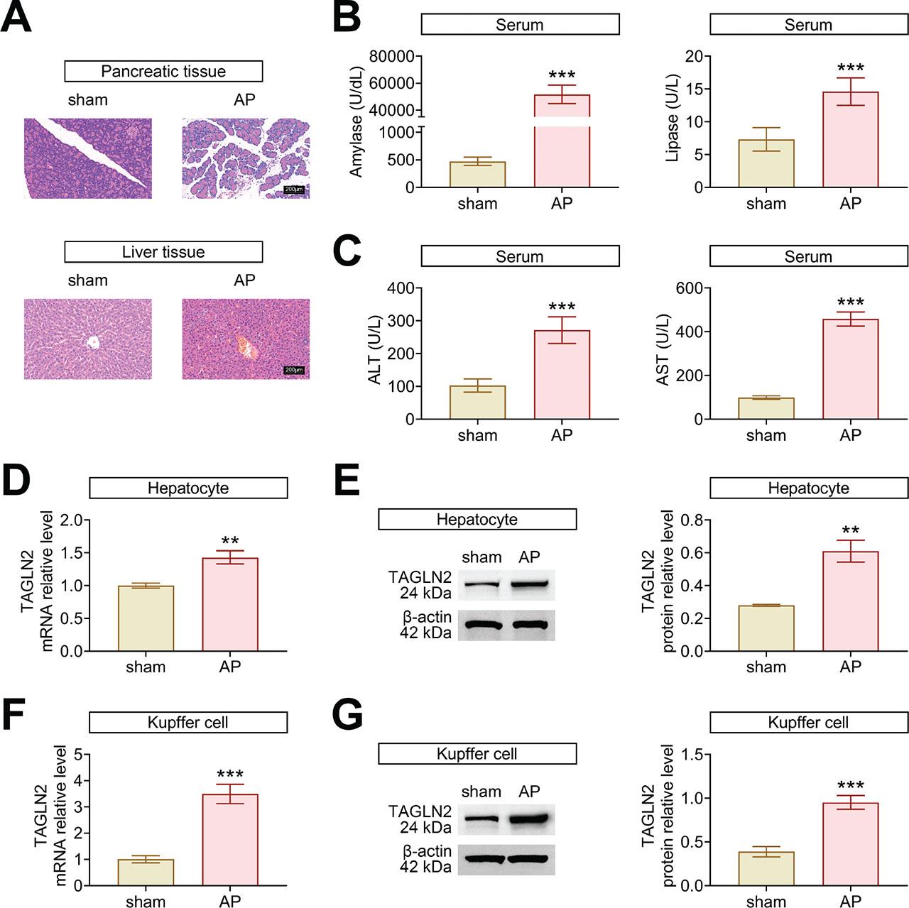 TAGLN2 is upregulated in AP-induced liver injury. Mice were treated with cerulein to induce AP. (a) The pathological changes in pancreatic and liver tissues were assessed by H&E staining. Scale bar = 200 μm. (b) The serum concentrations of amylase and lipase were measured by ELISA. (c) The serum concentrations of ALT and AST were measured by ELISA. (d) The relative mRNA expression of TAGLN2 in hepatocytes was examined by RT-qPCR. Data were expressed after being normalized with GAPDH. (e) The relative protein expression of TAGLN2 in hepatocytes was examined by western blotting. Data were expressed after being normalized with β-actin. (f) The relative mRNA expression of TAGLN2 in Kupffer cells was examined by RT-qPCR. Data were expressed after being normalized with GAPDH. (g) The relative protein expression of TAGLN2 in Kupffer cells was examined by western blotting. Data were expressed after being normalized with β-actin. *p < 0.05, **p < 0.01 and ***p < 0.001 vs. sham. ALT, alanine aminotransferase; AP, acute pancreatitis; AST, aspartate transaminase; ELISA, enzyme-linked immunosorbent assay; H&E, Hematoxylin and eosin; TAGLN2, transgelin-2.