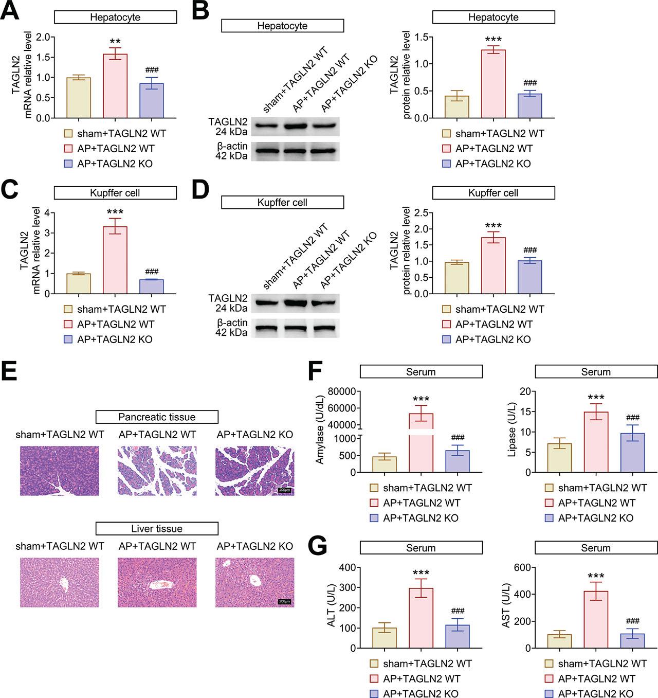 TAGLN2 knockout reduces AP and AP-induced liver injury. (a) The relative mRNA expression of TAGLN2 in hepatocytes was examined by RT-qPCR. Data were expressed after being normalized with GAPDH. (b) The relative protein expression of TAGLN2 in hepatocytes was examined by western blotting. Data were expressed after being normalized with β-actin. (c) The relative mRNA expression of TAGLN2 in Kupffer cells was examined by RT-qPCR. Data were expressed after being normalized with GAPDH. (d) The relative protein expression of TAGLN2 in Kupffer cells was examined by western blotting. Data were expressed after being normalized with β-actin. (e) The pathological changes in pancreatic and liver tissues were assessed by HE staining. Scale bar = 200 μm. (f) The serum concentrations of amylase and lipase were measured by ELISA. (g) The serum concentrations of ALT and AST were measured by ELISA. *p < 0.05, **p < 0.01 and ***p < 0.001 vs. sham + TAGLN2 WT; #p < 0.05, ##p < 0.01 and ###p < 0.001 vs. AP + TAGLN2 WT. ALT, alanine aminotransferase; AP, acute pancreatitis; AST, aspartate transaminase; ELISA, enzyme-linked immunosorbent assay; TAGLN2, transgelin-2; WT, wild type.