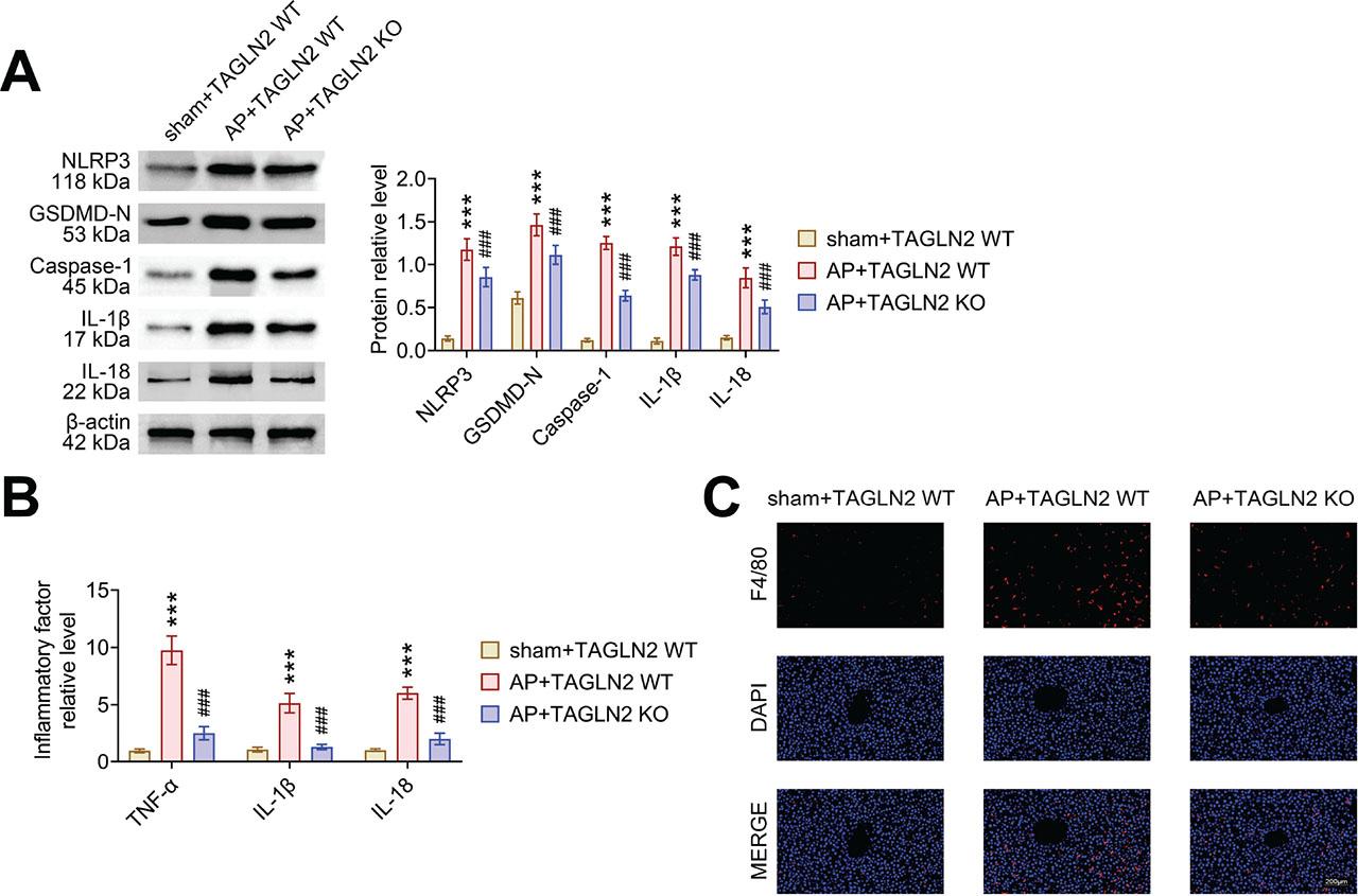 TAGLN2 knockout decreases liver tissue pyroptosis in AP mice. TAGLN2 KO mice were treated with cerulein to induce AP. (a) The relative protein expressions of NLRP3, GSDMD-N, caspase-1, IL-1β, and IL-18 in liver tissues were examined by western blotting. Data were expressed after being normalized with β-actin. (b) The concentrations of TNF-α, IL-1β, and IL-18 in liver tissues were measured by ELISA. (c) The level of F4/80 was detected by immunofluorescence assay. Scale bar = 200 μm. *p < 0.05,**p < 0.01 ***p < 0.001 vs. sham + TAGLN2 WT; #p < 0.05, ##p < 0.01 and ###p < 0.001 vs. AP + TAGLN2 WT. AP, acute pancreatitis; ELISA, enzyme-linked immunosorbent assay; IL, interleukin; KO, knock out; TAGLN2, transgelin-2; WT, wild type.
