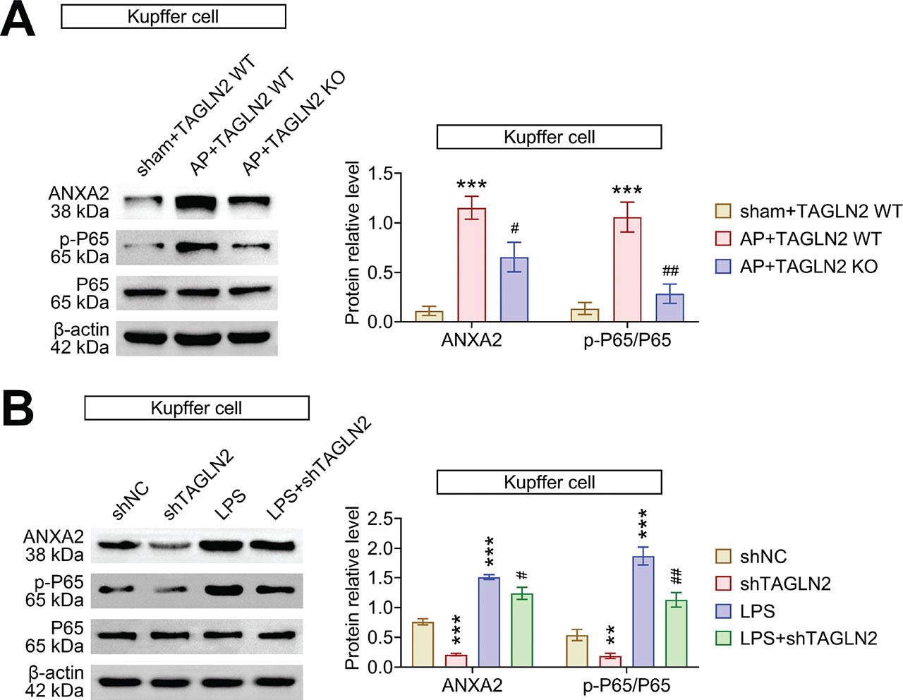 TAGLN2 enhances the activation of ANXA2/NF-κB axis in Kupffer cells. (a) The relative protein expression of ANXA2, p-P65 and P65 in Kupffer cells from mice was examined by western blotting. Data were expressed after being normalized with β-actin. ***p < 0.001 vs. sham + TAGLN2 WT; #p < 0.05 and ##p < 0.01 vs. AP + TAGLN2 WT. (b) The relative protein expression of ANXA2, p-P65 and P65 in Kupffer cells in vitro was examined by western blotting. Data were expressed after being normalized with β-actin. *p < 0.05, **p < 0.01 and ***p < 0.001 vs. shNC; #p < 0.05,##p < 0.01 and ###p < 0.001 vs. shTAGLN2. AP, acute pancreatitis; LPS, lipopolysaccharide; TAGLN2, transgelin-2; WT, wild type.