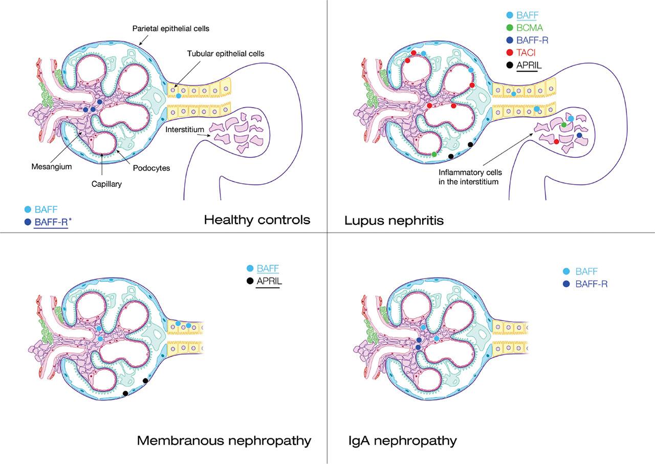 The expression of B-cell activation receptors and molecules reported in various studies. Underlined data come from mRNA analysis. *Identified both by mRNA and immunohistochemistry analysis (Zheng et al. 2015; Han et al. 2018; Cao et al. 2020; Forero-Delgadillo et al. 2022; Marín-Rosales et al. 2022). Both immunohistochemistry staining and mRNA expression were used in independent research, which probably influence incoherent results. APRIL, A PRoliferation-Inducing Ligand; BAFF, B-cell-activating factor; BAFF-R, BAFF receptor; BCMA, B-cell maturation antigen; TACI, Transmembrane activator and calcium-modulator and cyclophilin ligand interactor.