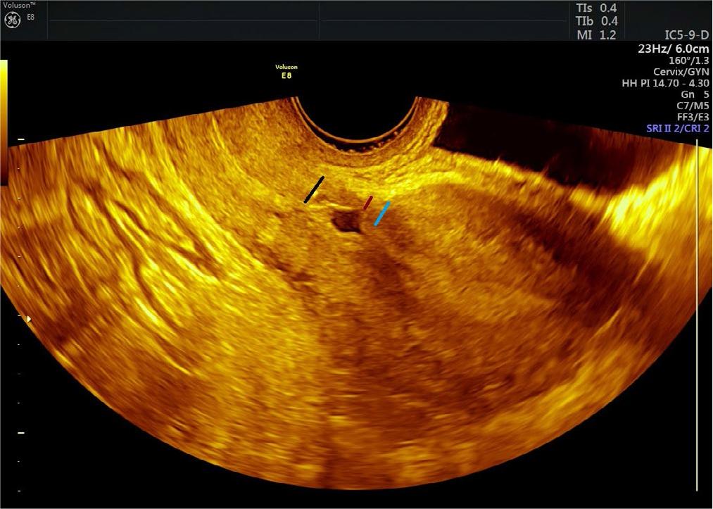 Cesarean section incision area healed with a niche. The red line indicates residual myometrial thickness (RMT), the blue line indicates proximal RMT, and the black line indicates distal RMT
