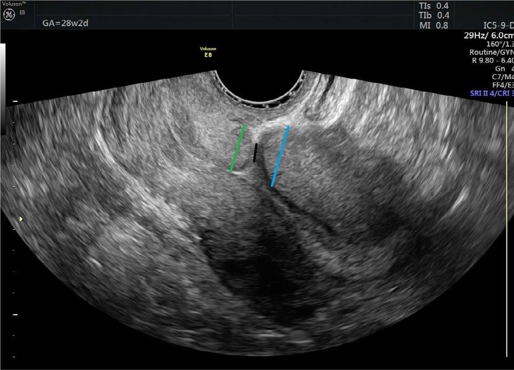 Cesarean scar incision area healed with fibrosis. The black line indicates residual myometrial thickness (RMT), the blue line indicates proximal RMT, and the green line indicates distal RMT