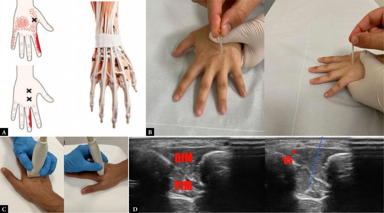 A. Referred pain areas of interosseous muscles trigger points; B. dry needling technique with flat palpation and perpendicular application, top and side views; C. ultrasound-guided approach, placement of the ultrasound probe and dry needling position; D. ultrasound imaging of dorsal and palmar interosseous muscles, with avoidance of superficial veins. The figures are published with the permission of Hipokrat Kitabevi