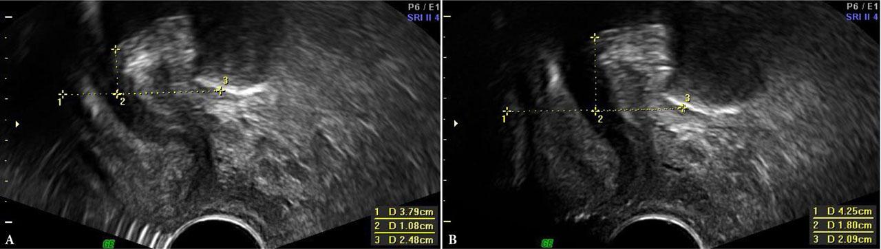 PFS-TV – measurement of urethral mobility parameters at rest and on PFMC. A. At rest. B. On PFMC. 1 – horizontal axis; 2 –H; 3 –D