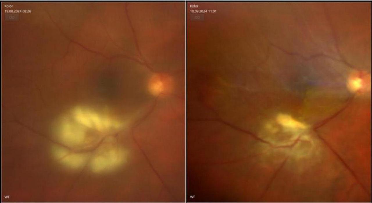 Fundus photo of the right eye with inflamatory chorioretinal changes –the left side pre-treatment and on the right site there’s an image made after the treatment