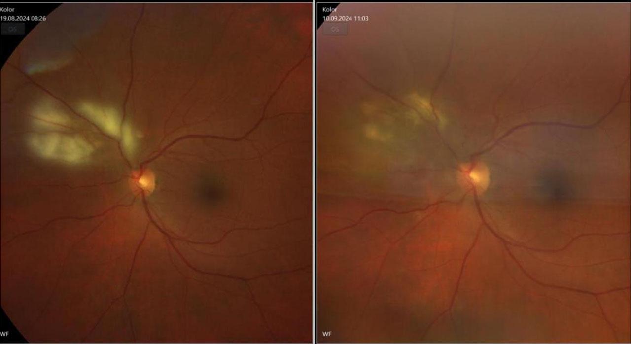 Fundus photo of the left eye with inflamatory chorioretinal changes – on the left side pre-treatment and on the right side there’s an image made after the treatment