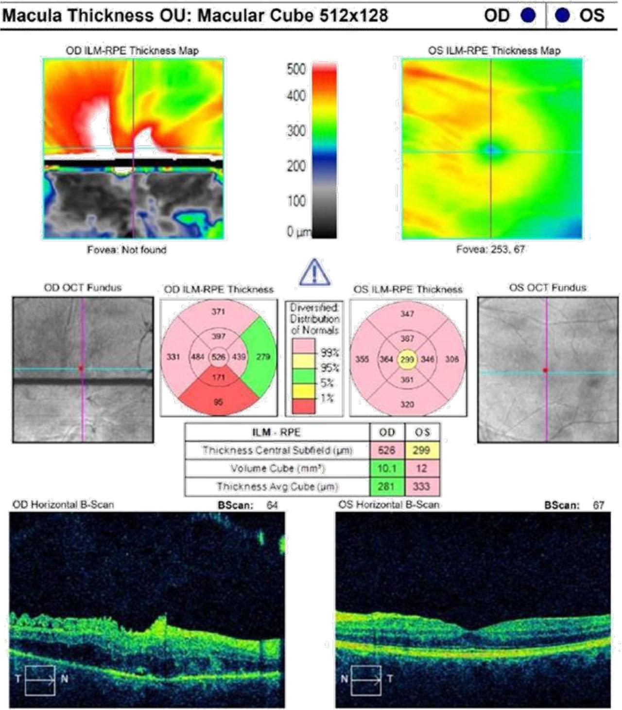 OCT through inflammatory changes of the right eye: RPE preserved, with visible edema of the retinal layers and hyperreflectivity of the inner retinal layers and the left eye: normal RPE