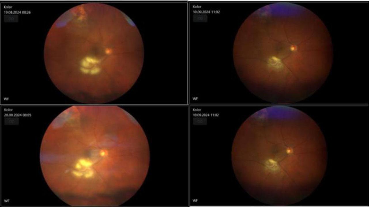 Fundus photo of the right eye shows changes of inflammation before the treatment and after it