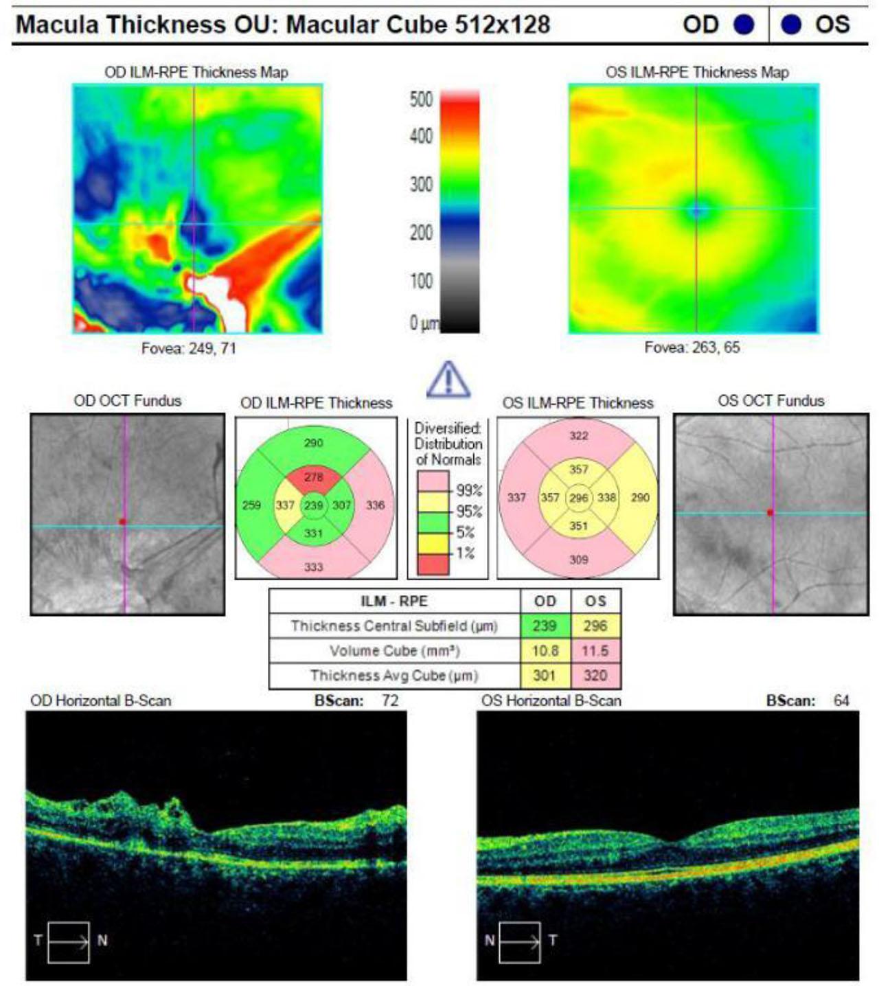 OCT of the macula was performed, revealing RPE thinning and ERM with irregular surface the right eye, while the foveal morphology in the left eye remained preserved