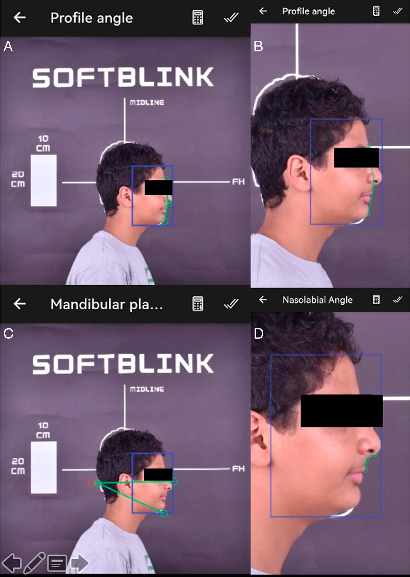 Soft tissue measurements calculated using the SOFTBLINK application; A&B showing the profile angle, C showing the mandibular plane angle and D showing the nasolabial angle.