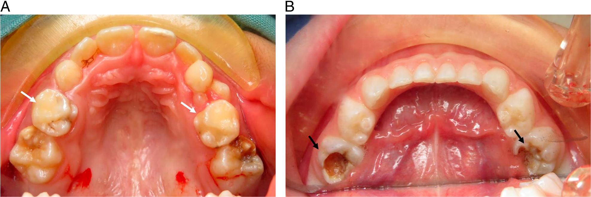Clinical photographs of (A) upper second primary molars affected with mild hypomineralisation of yellow/white demarcated defects and previous atypical restorations (white arrows) with affected first permanent molars and (B) lower first primary molars with large, atypical caries affecting the occlusal, buccal and lingual surfaces (black arrows).