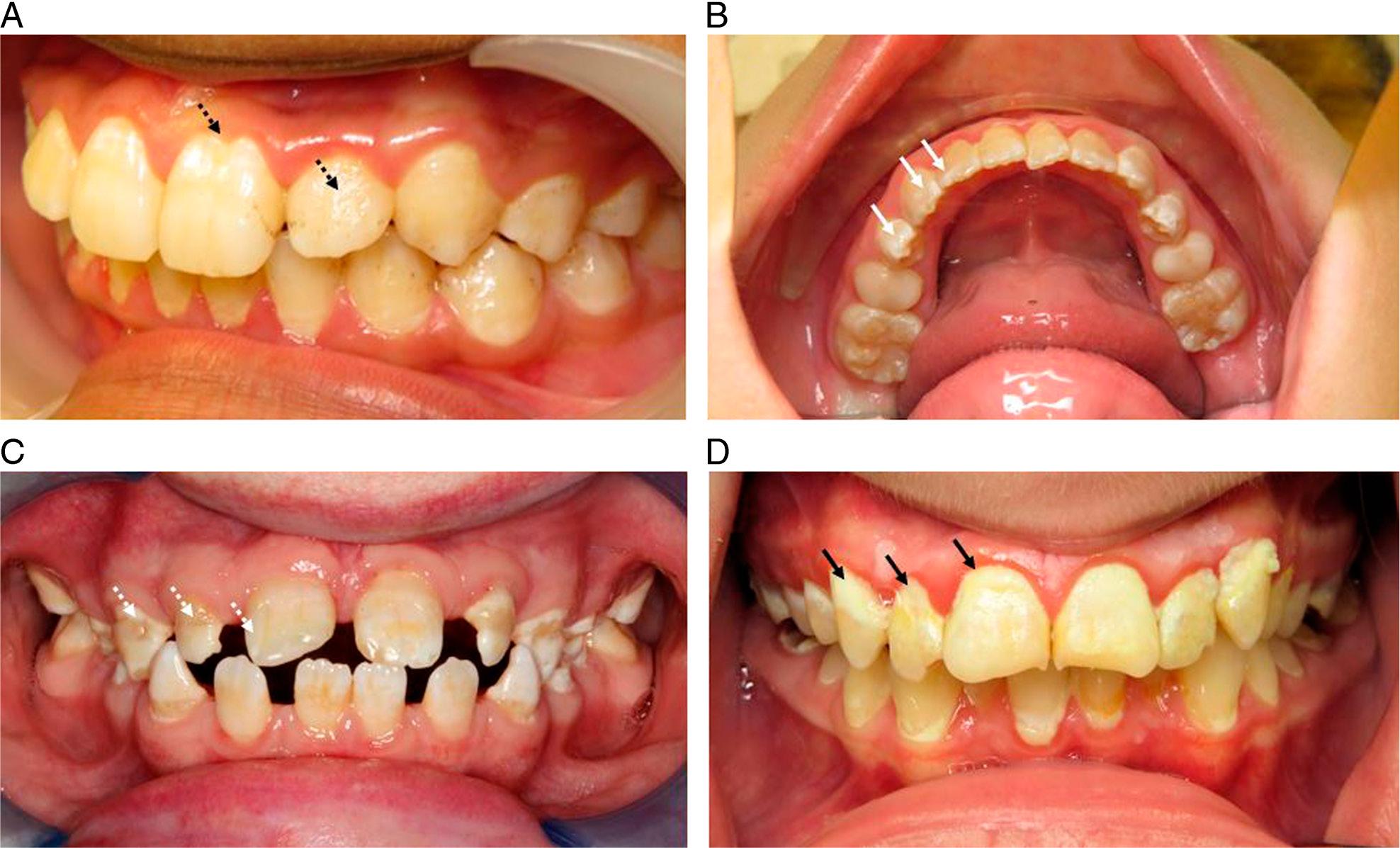 Clinical photographs of (A) hypoplastic quantitative defect on the upper left central incisor and diffuse defect across all other maxillary teeth (black dashed arrows), (B) fluorosis with diffuse, opaque defects (white arrows) affecting all of the lower permanent dentition, (C) amelogenesis imperfecta with diffuse areas of white and brown defects (white dashed arrow) affecting all permanent dentition, (D) white-spot caries lesions at the gingival margins of multiple teeth (black arrows).