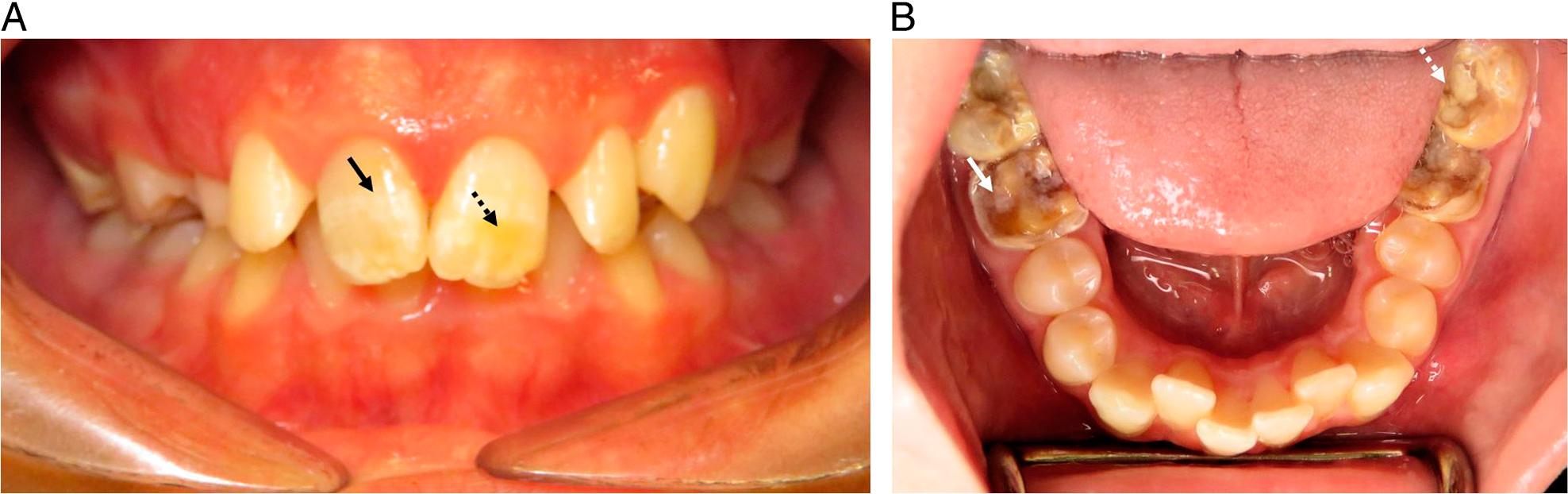Clinical photographs of (A) upper central incisors with white (black arrow) and yellow (black dashed arrow) demarcated defects and (A) lower first and second permanent molars with posteruptive breakdown of the occlusal and buccal surfaces (white arrow) and an atypical restoration (white dashed arrow).