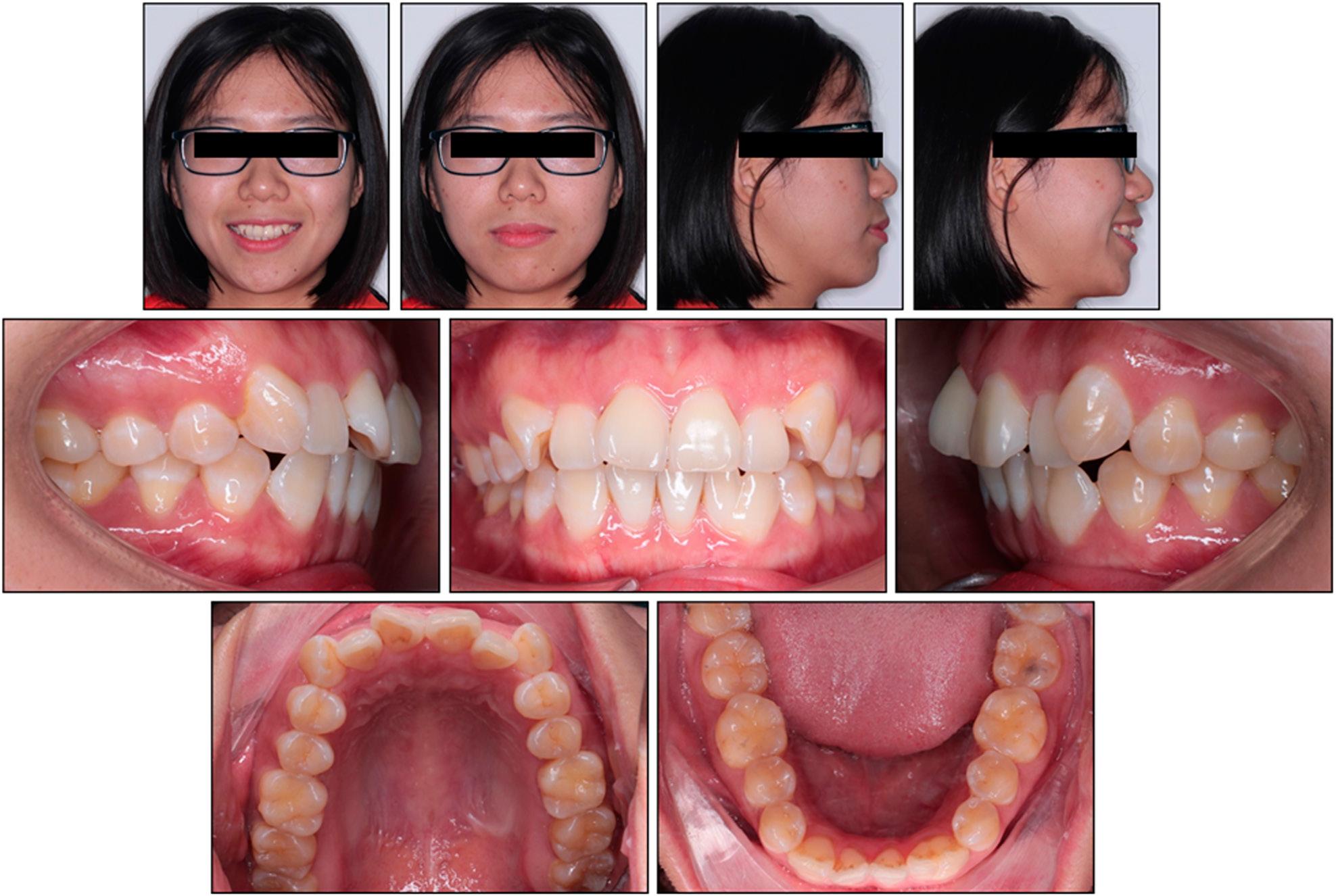 Initial extra- and intra-oral clinical photographs.
