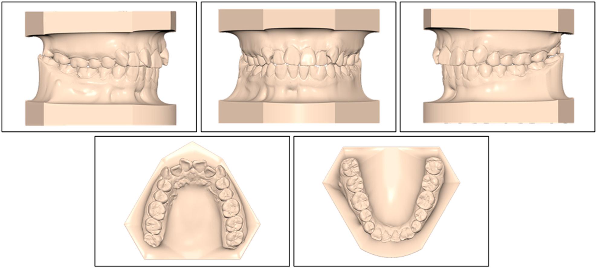 Pretreatment maxillary and mandibular study models.