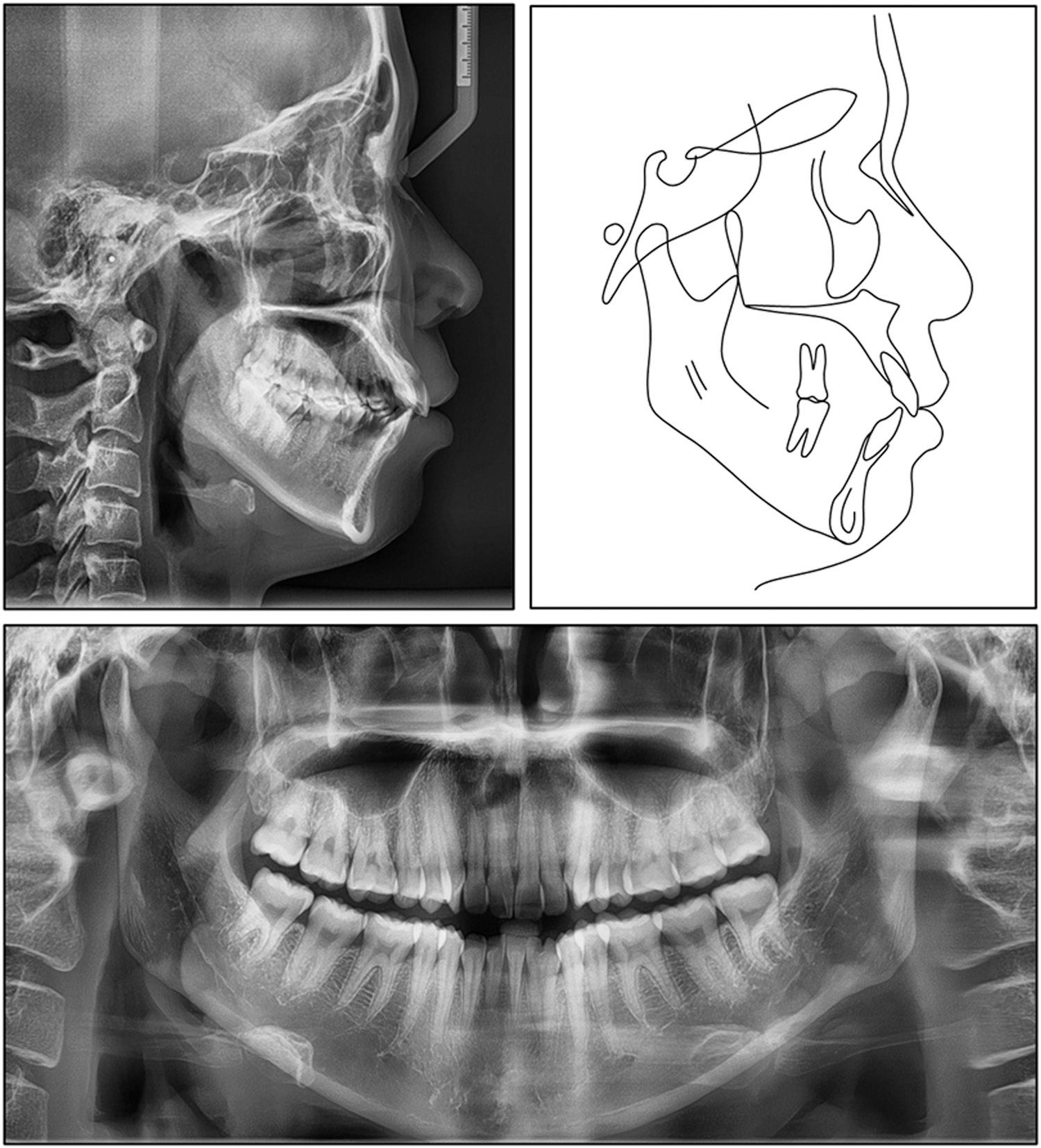 Pretreatment lateral cephalogram, panoramic radiograph, and tracing.