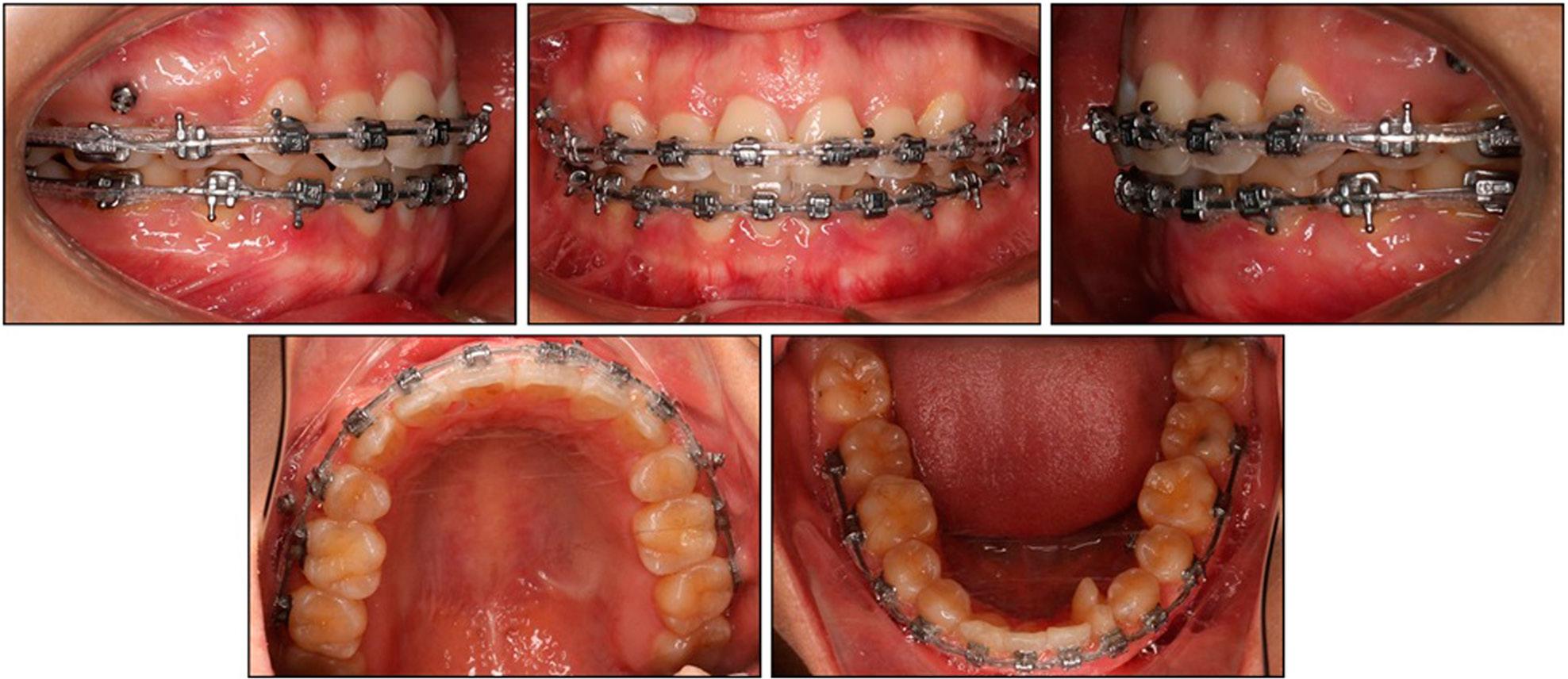 Clinical photographs after 13 months of treatment.