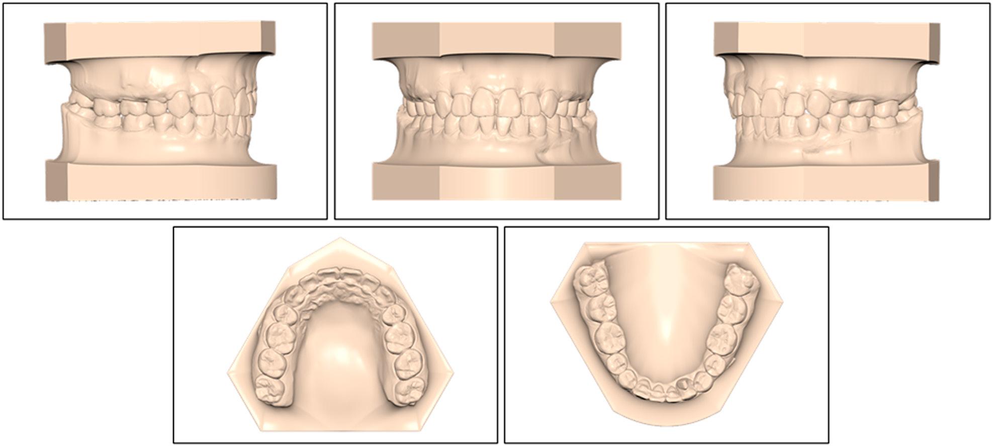 Post-treatment maxillary and mandibular study models.