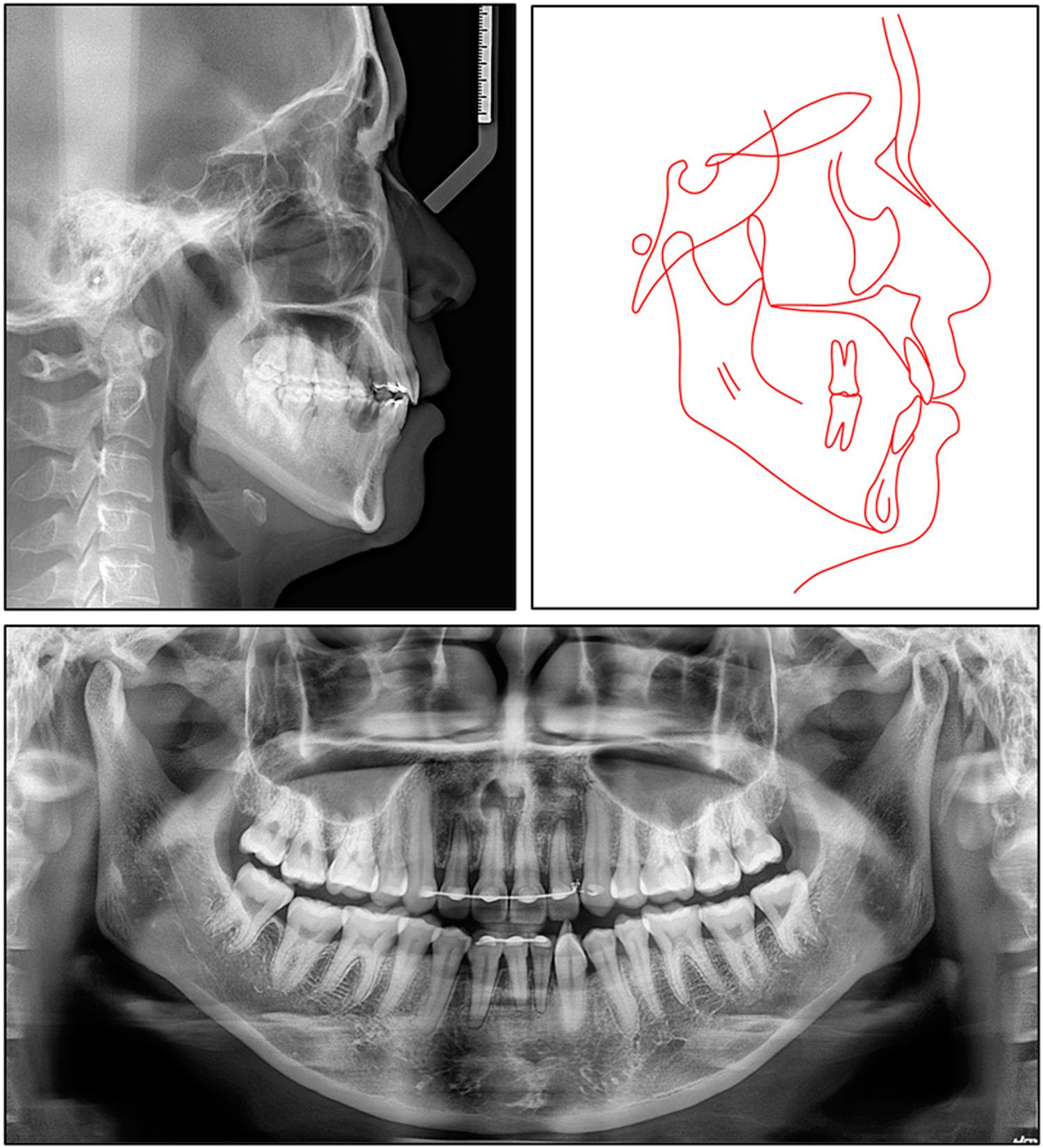 Post-treatment lateral cephalogram, panoramic radiograph, and tracing.