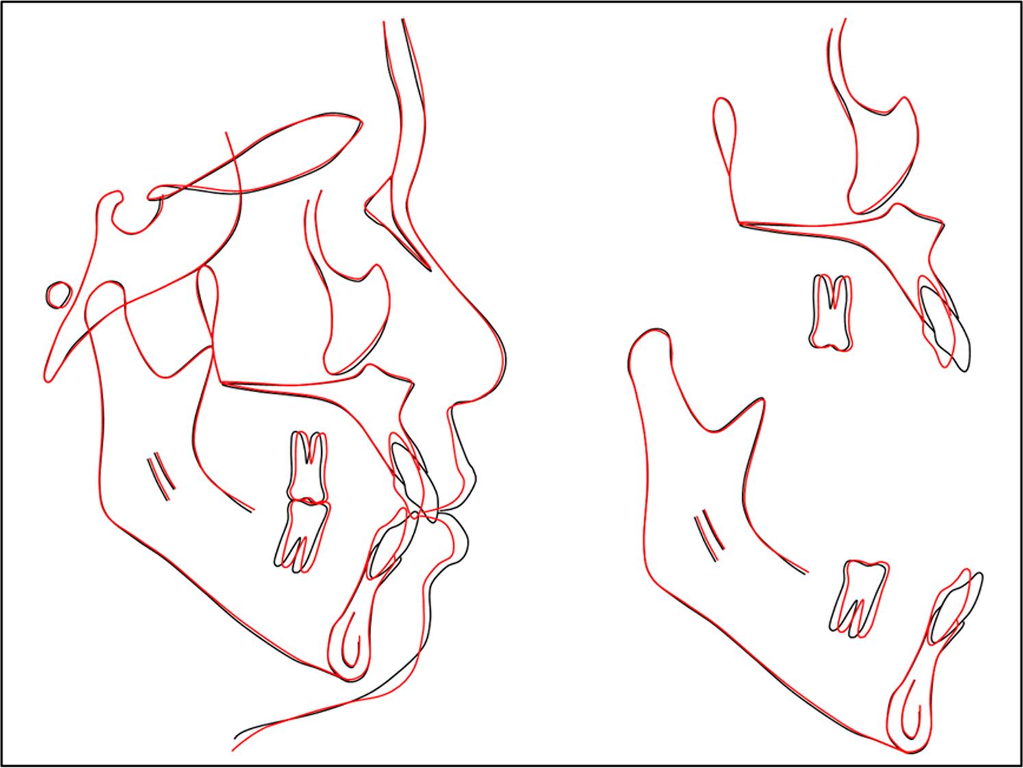 Superimposed pretreatment and post-treatment cephalometric tracings.