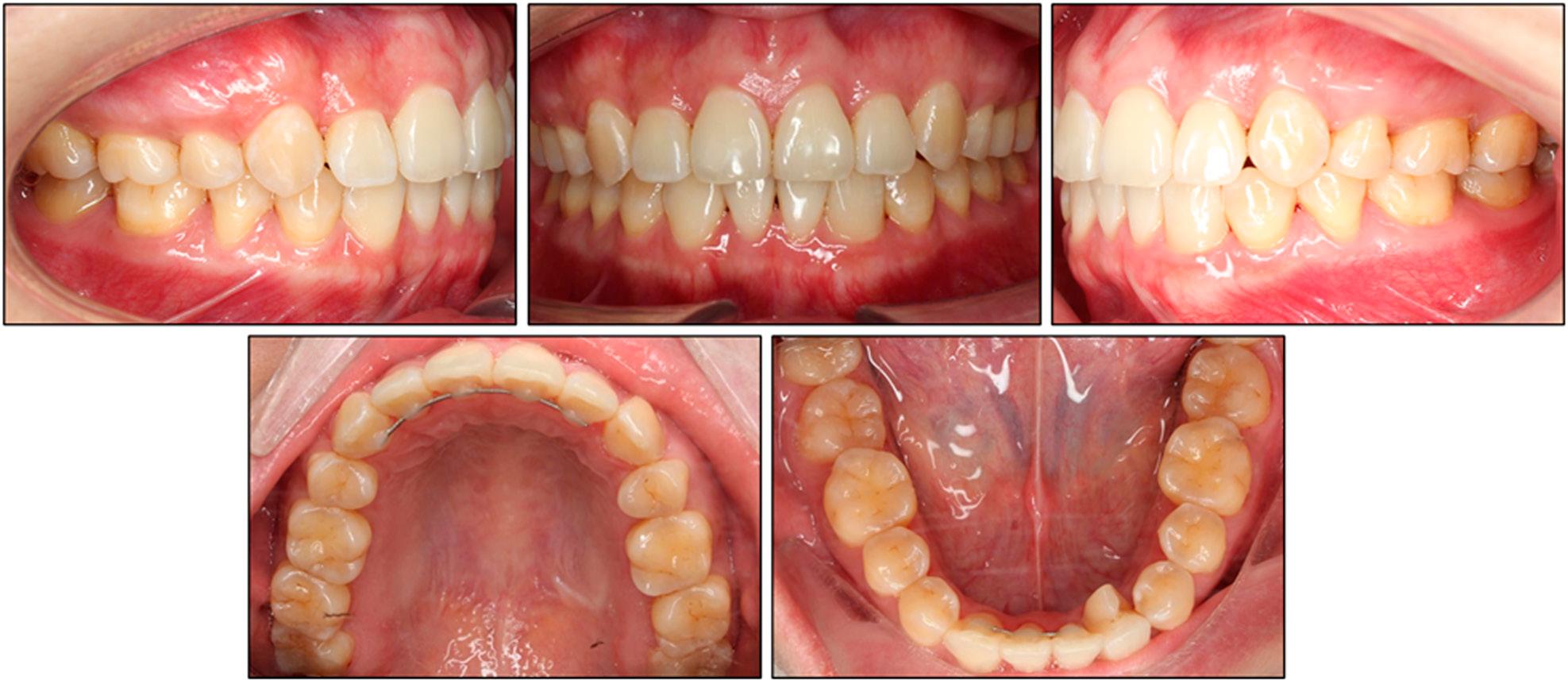 Three-year retention intra-oral photographs.