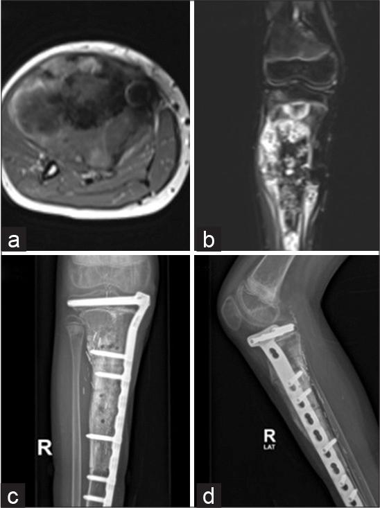 Magnetic resonance imaging (MRI) axial (a) and coronal (b) views of 12-year-old male having osteosarcoma who underwent reconstruction with liquid nitrogen treated bone as shown in X-ray tibia anteroposterior (c) and lateral (d) views