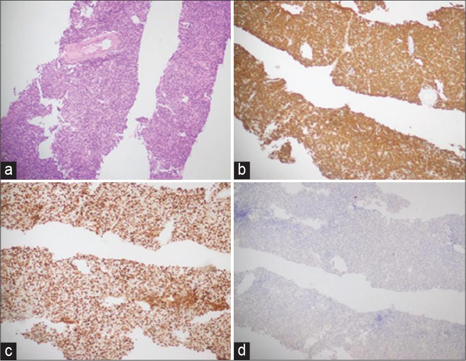 (a) Right axillary lymph node trucut biopsy; diffuse large B-cell lymphoma. (b) CD 20: Positive in tumor cells. (c) Ki67; 50% proliferation index in tumor cells. (d) Cytokeratin; negative in tumor cells