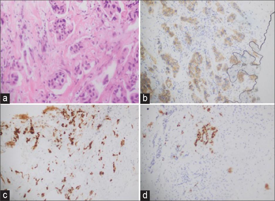 (a) Right breast trucut biopsy: Invasive breast carcinoma, no special type (ductal), grade II. (b) Her 2: Equivocal: Score 2+ (uniform, intense complete membranous staining in: 5–10% cells). (c) Estrogen receptor; positive, strong staining in 95% of tumor cells. (d) progesterone receptor; positive, strong staining in 50% of tumor cells