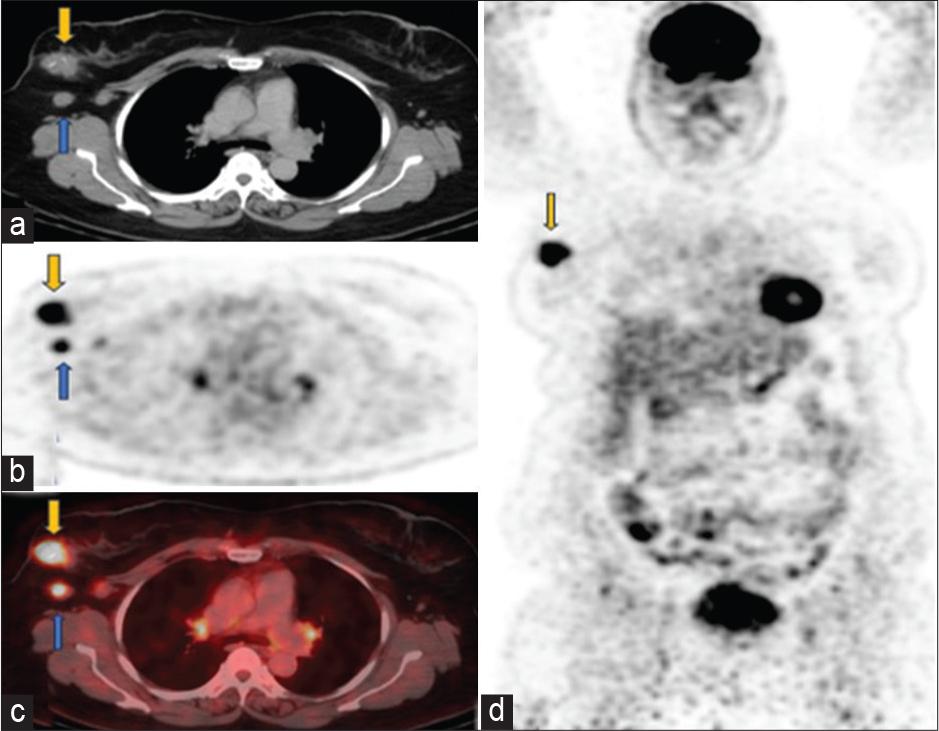 Baseline scan April 2023 (a) axial computed tomography (CT), (b) positron emission tomography only, (c) fused positron emission tomography-CT images through the chest showed fludeoxyglucose (FDG) avid soft tissue mass in the upper outer quadrant of right breast (yellow arrow) has SUV 7.4. FDG avid right axillary lymph nodes (SUV 3.7) are marked with blue arrows, consistent with DLBCL. Small volume mildly avid mediastinal and hilar lymph nodes are likely reactive. (d) Coronal positron emission tomography-only images show hypermetabolic right breast biopsy-proven ductal carcinoma in situ