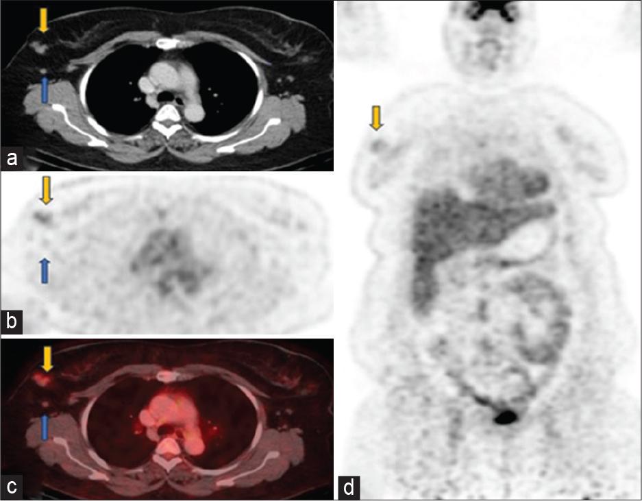 Follow-up scan June 2023 (a) axial computed tomography (CT), (b) positron emission tomography only, (c) fused positron emission tomography-CT images through the chest showed significant interval decrease in size and metabolic activity of right breast mgass (yellow arrows) with faint uptake (SUV 2.6). Right axillary lymphadenopathy has also significantly reduced leaving behind residual non-avid (SUV 1.2) subcentimeter nodes (blue arrows). (d) Coronal positron emission tomography-only images showed a faintly avid residual tumor in the right breast