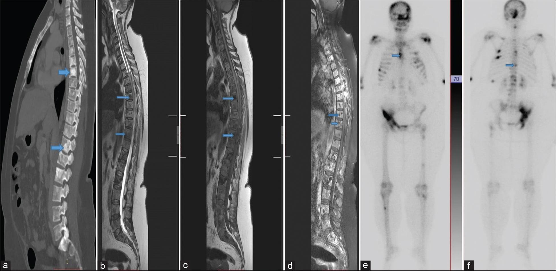Radiological representative images of bone metastasis: Images of a 50-year-old female patient of breast cancer with extensive axial skeleton osseous metastasis. Magnetic resonance imaging whole spine (a) T2 weighted, (b) T1 weighted, (c) contrast-enhanced mid-sagittal slices, (d) computed tomography scan mid-sagittal slice, bone window settings, and (e and f) Bone scan, anterior and posterior planer images. Blue arrows are sites of axial skeleton osseous metastasis.