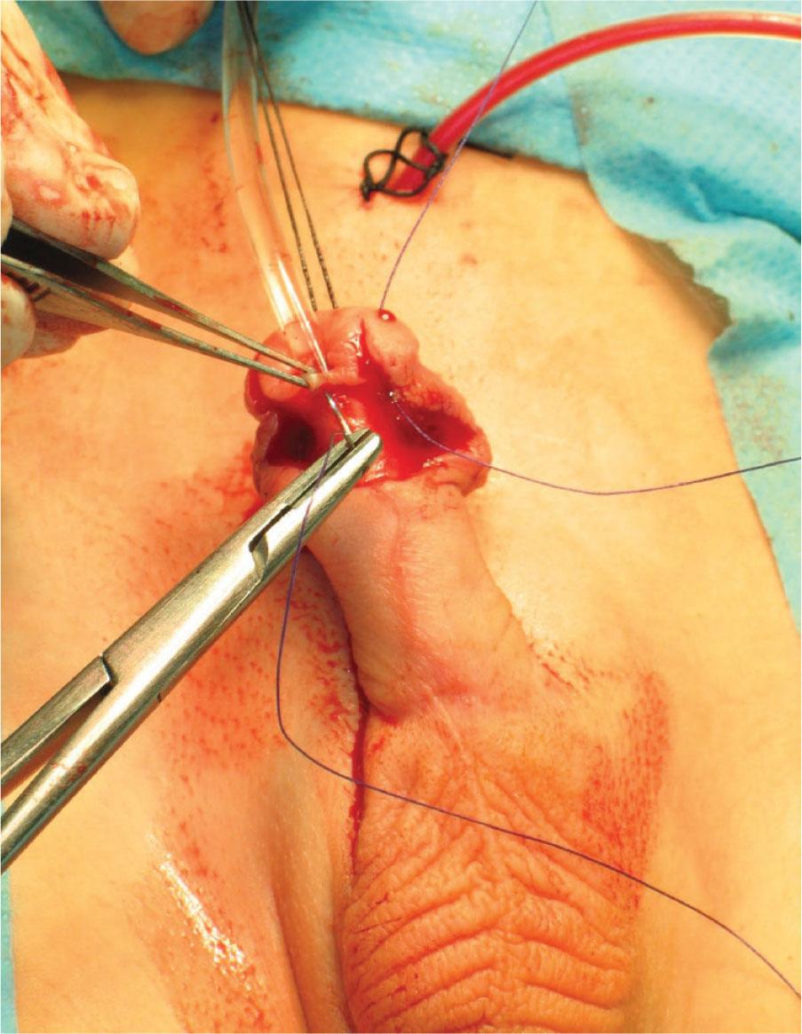 Blanket suture. Top of incision-centre of the urethra-across top of incision.