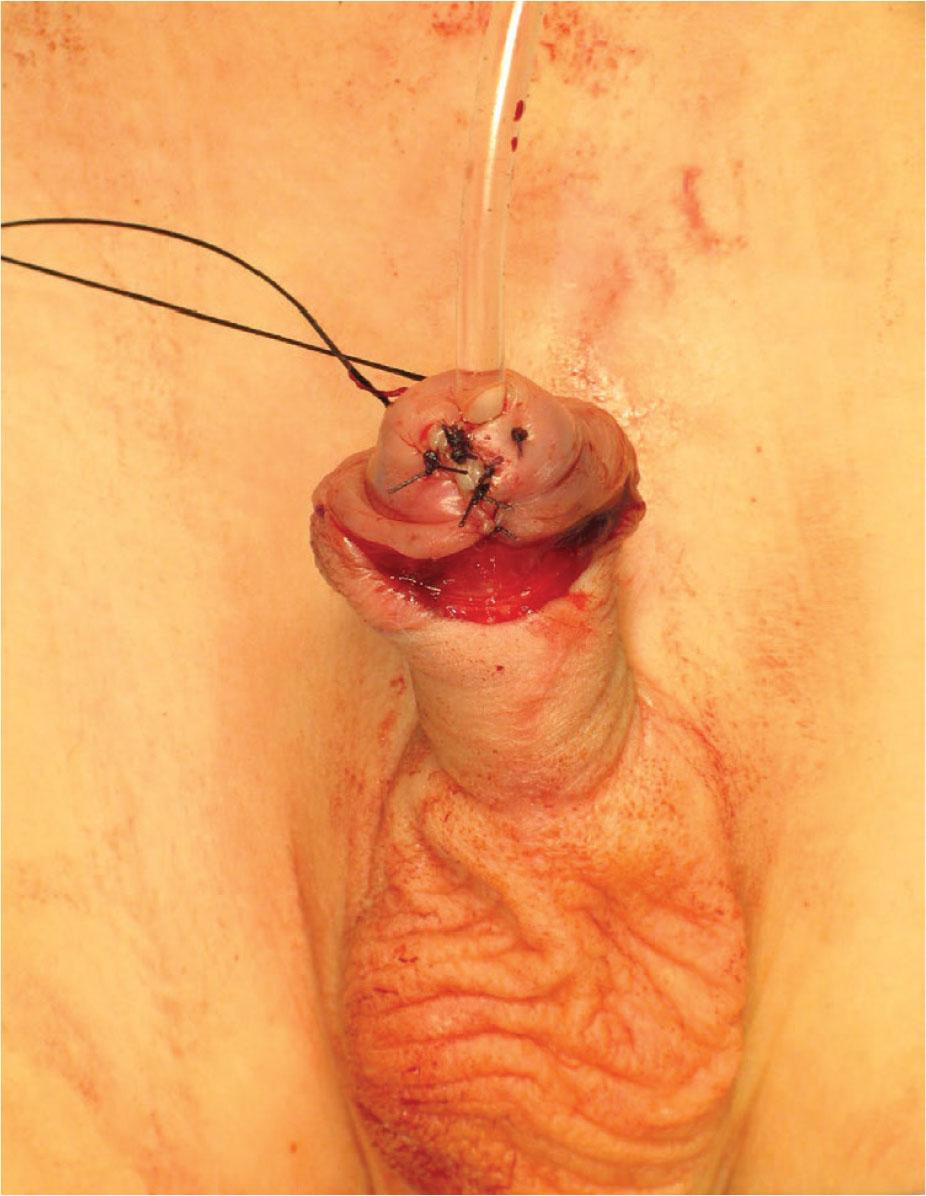 Glans blanket sutures.