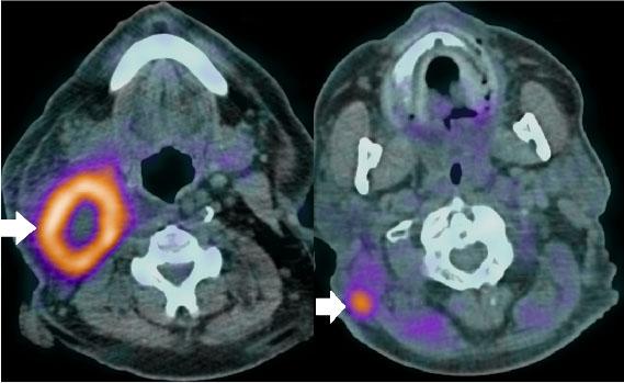 PET-CT showing a hypermetabolic submandibular lymph node block (primary tumor - left) and a suspicious, hypermetabolic. area on the right sternocleidomastoid (recurrence of squamous cell carcinoma - right).