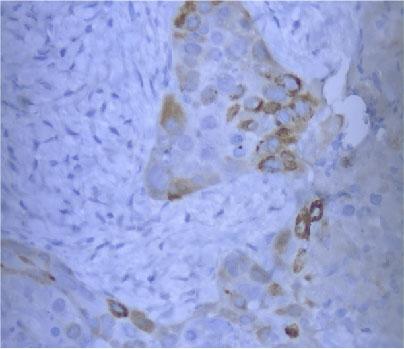 Histopathological examination of the postauricular lesion, revealing scattered p16+ cells, indicative of recurrent squamous cell carcinoma, HPV related.