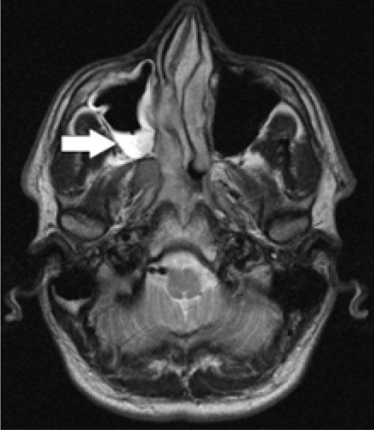 Brain MRI scan demonstrating a space-occupying lesion in the right nasal cavity with heterogenous contrast enhancement.