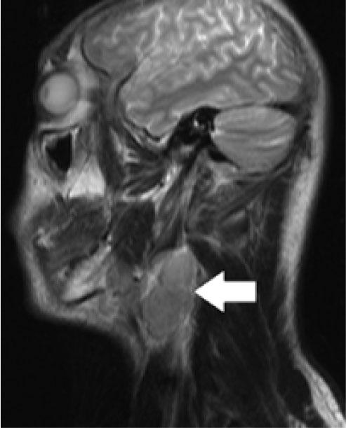 Brain MRI scan (sagittal) demonstrating a large lymph node block in the right submandibular region.