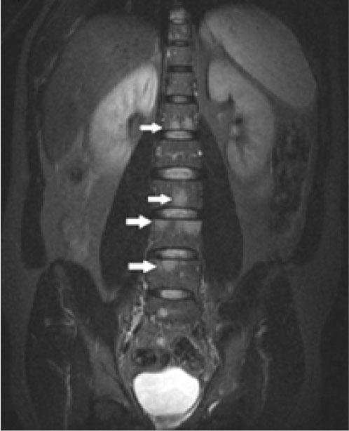 Spinal MRI scan (coronal) showing multiple bone-lytic lesions indicative of metastases along the spine.