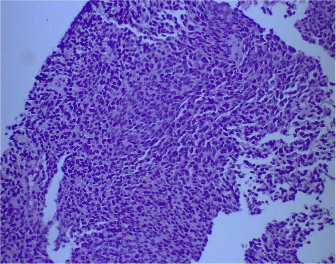 Histopathological examination reveals characteristics of a small round blue cells tumor (hematoxylin–eosin stain, x20 magnification).