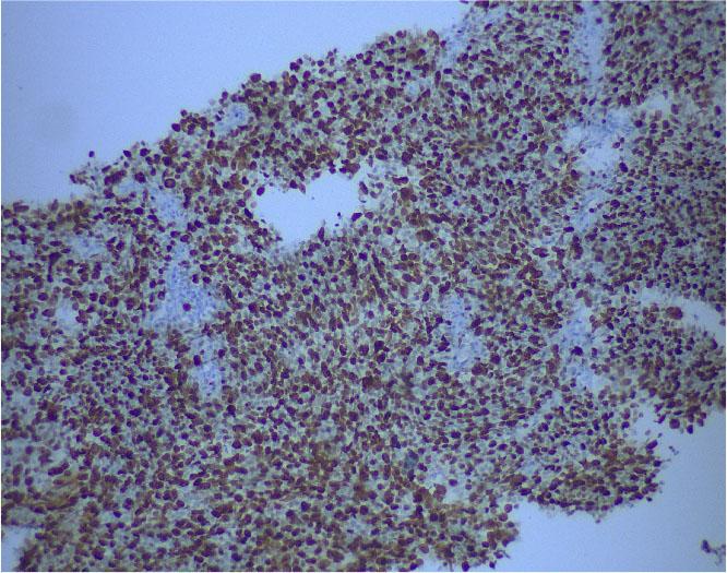 Tumor cells display a high ki67 proliferation index (ki67 85%, x10 magnification).