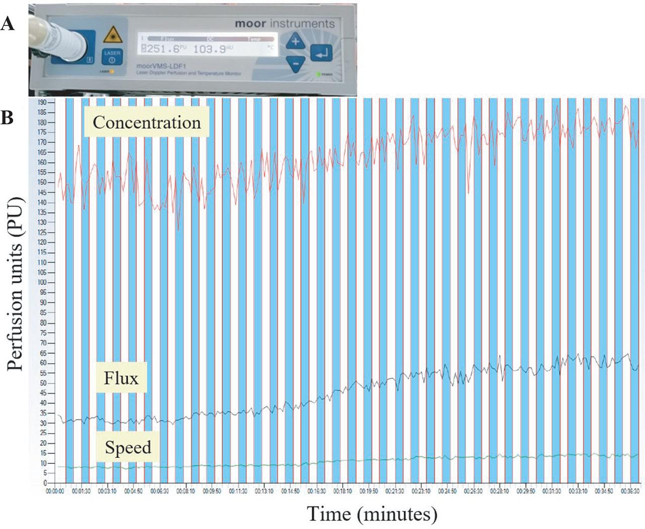 (A) High power LDF device and (B) data collection from HD patients. HD, hemodialysis; LDF, laser Doppler flowmetry.