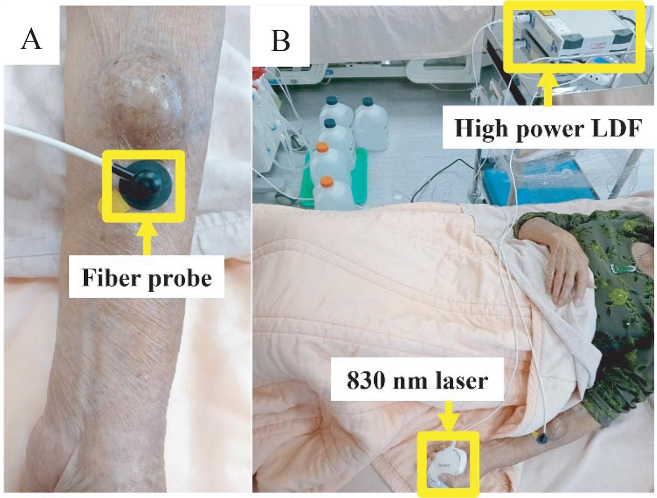 (A) The fiber probe of the high-power LDF was placed at the edge of the AVF. (B) The actual tested situation of HD patients receiving 830 nm laser on the palm. AVF, arteriovenous fistula; HD, hemodialysis; LDF, laser Doppler flowmetry.