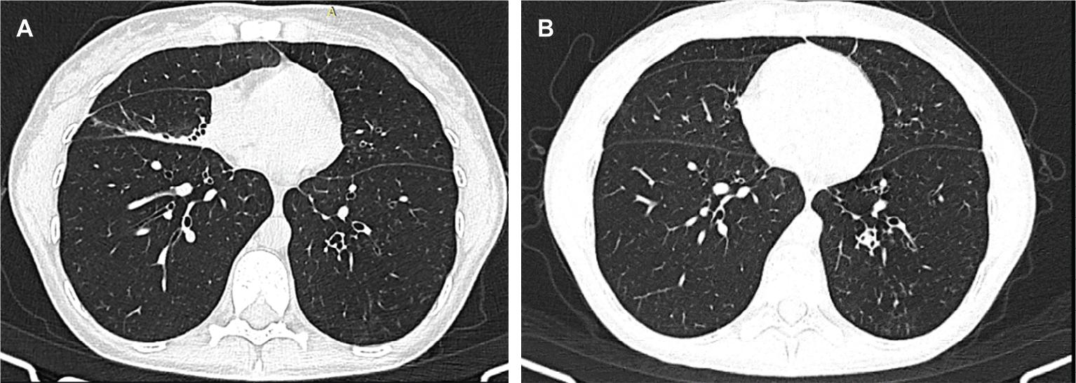 Chest CT image (A) at the first presentation: the appearance of ‘middle lobe syndrome’. (B) After 8 months of treatment: re-expansion of the partial atelectasis of the middle lobe.