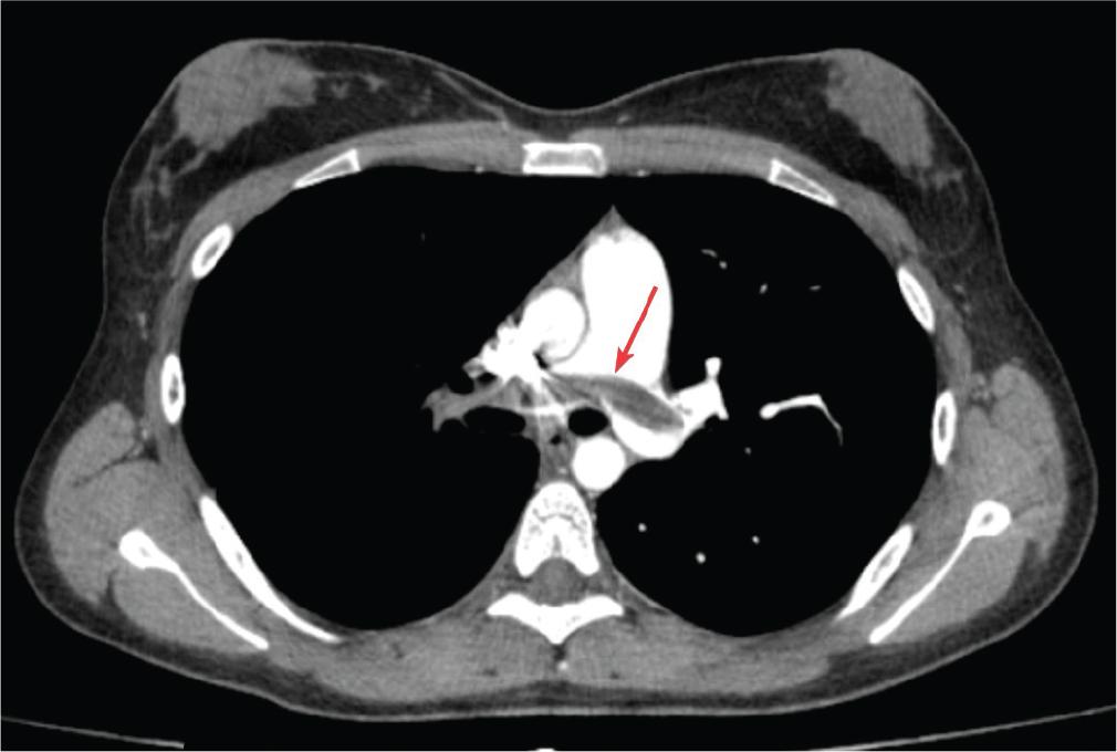 Contrast-enhanced chest CT scan: massive occlusive PE in the ‘saddle’ of the pulmonary trunk. CT, computed tomography; PE, pulmonary thromboembolism.