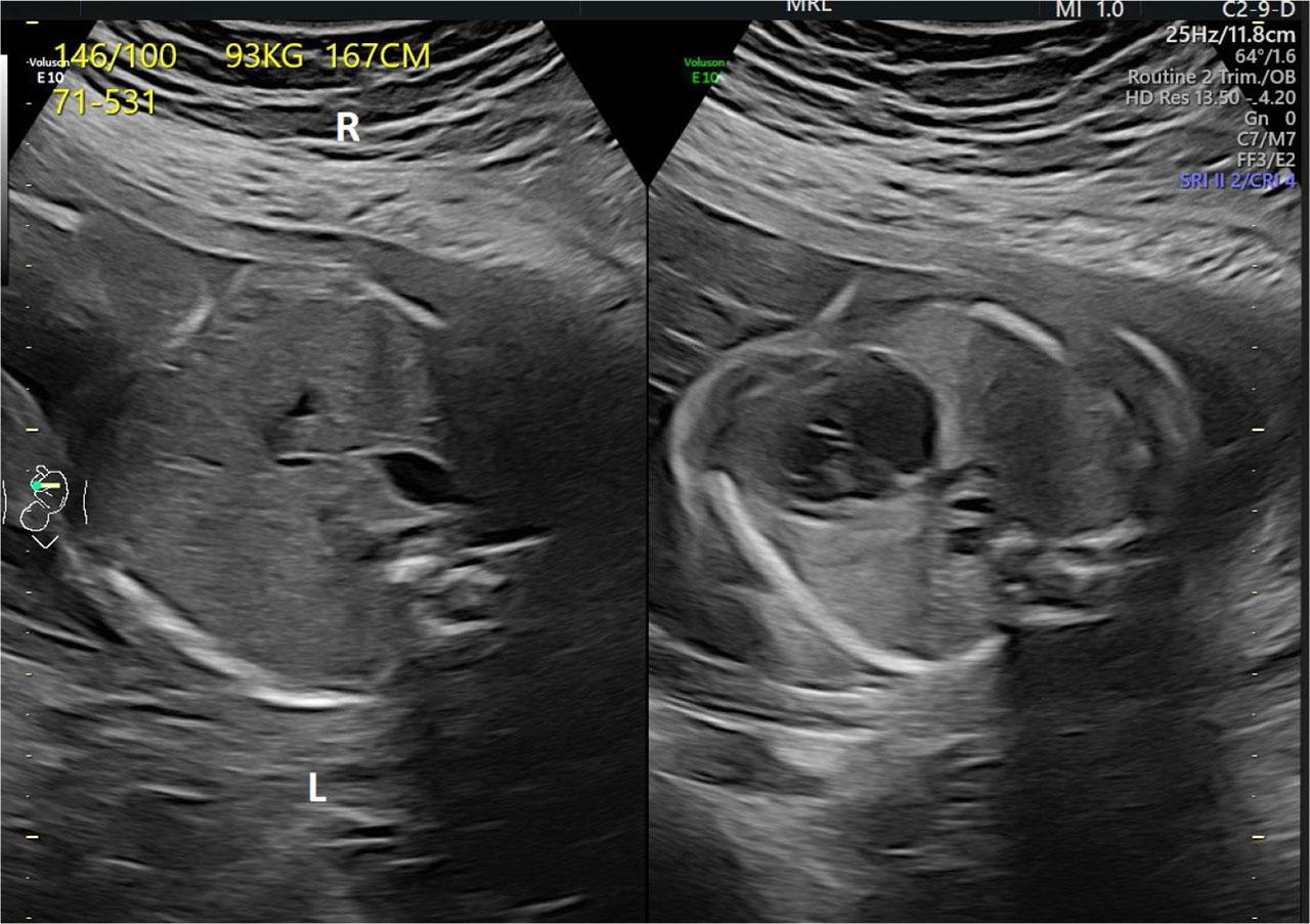 Situs inversus with levocardia during prenatal screening at 24.2 weeks of gestation