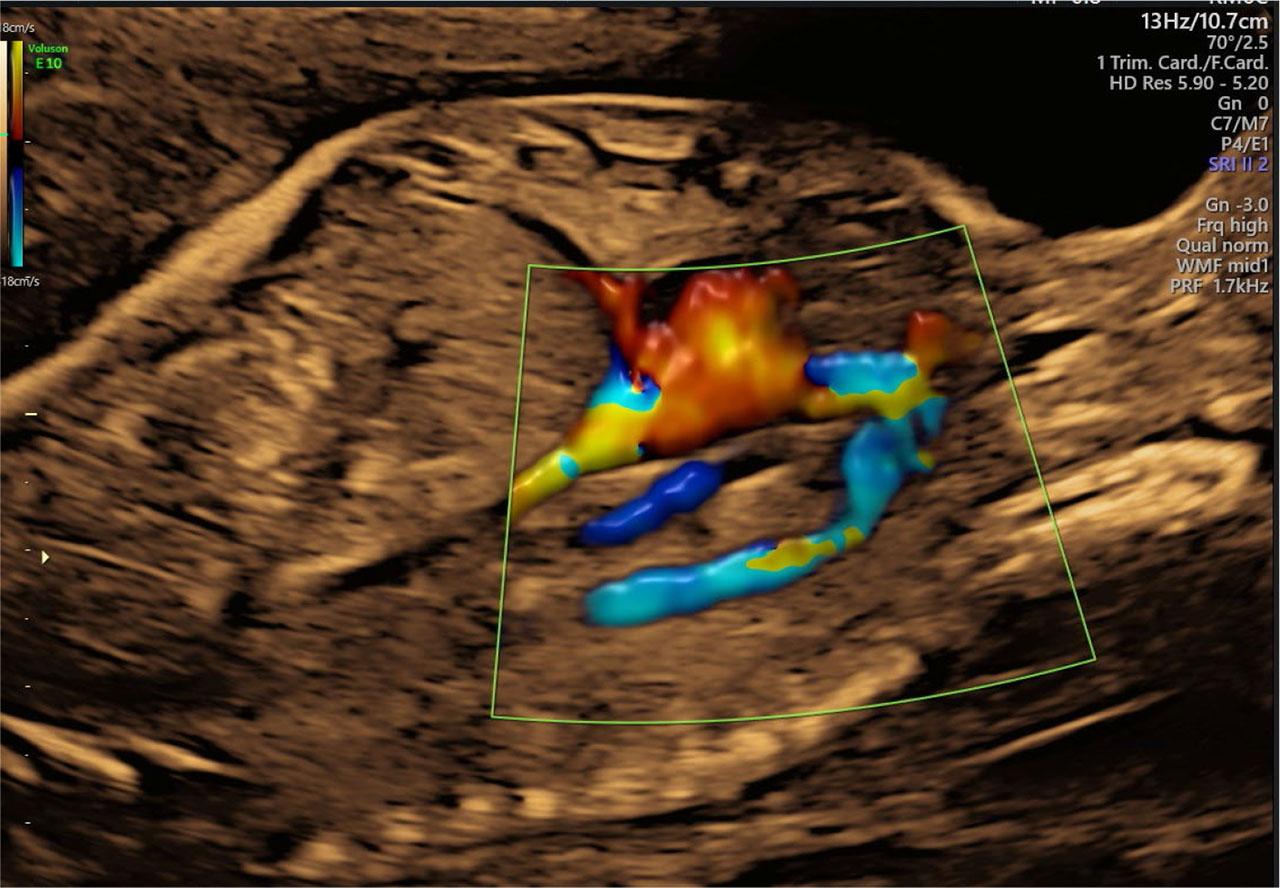 Abnormal vessel found during prenatal ultrasound screening at 24.2 weeks of gestation