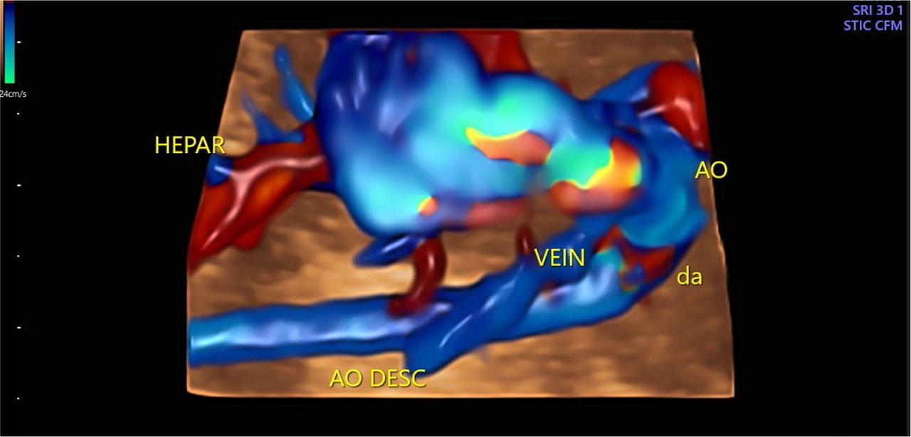 Abnormal vessel in 3D presentation at 24.2 weeks of gestation